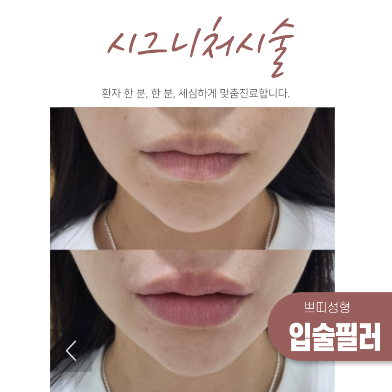 아이필유 시그니처 시술