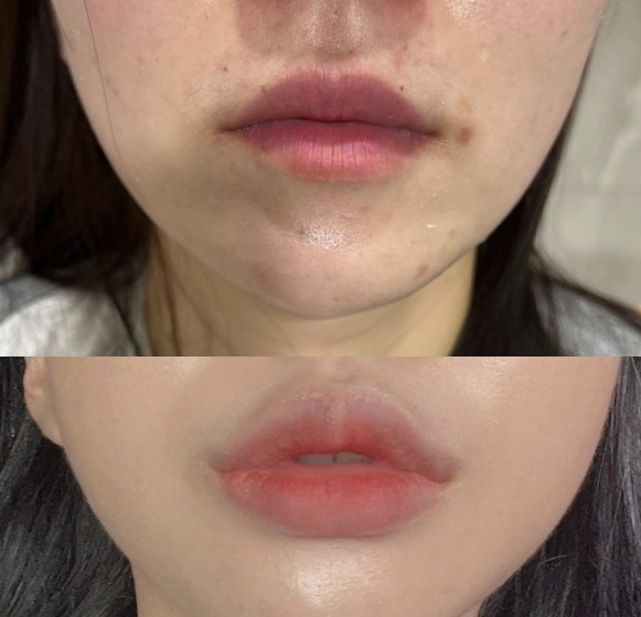 입술필러5.png