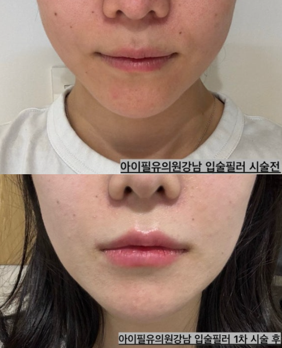 입술필러7.png
