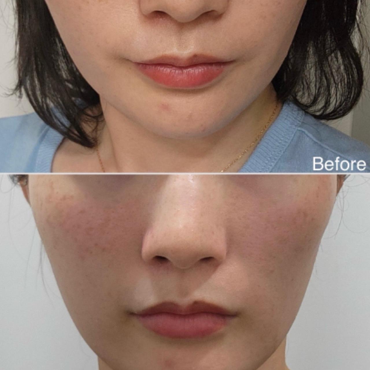 올리디아 (옆볼)