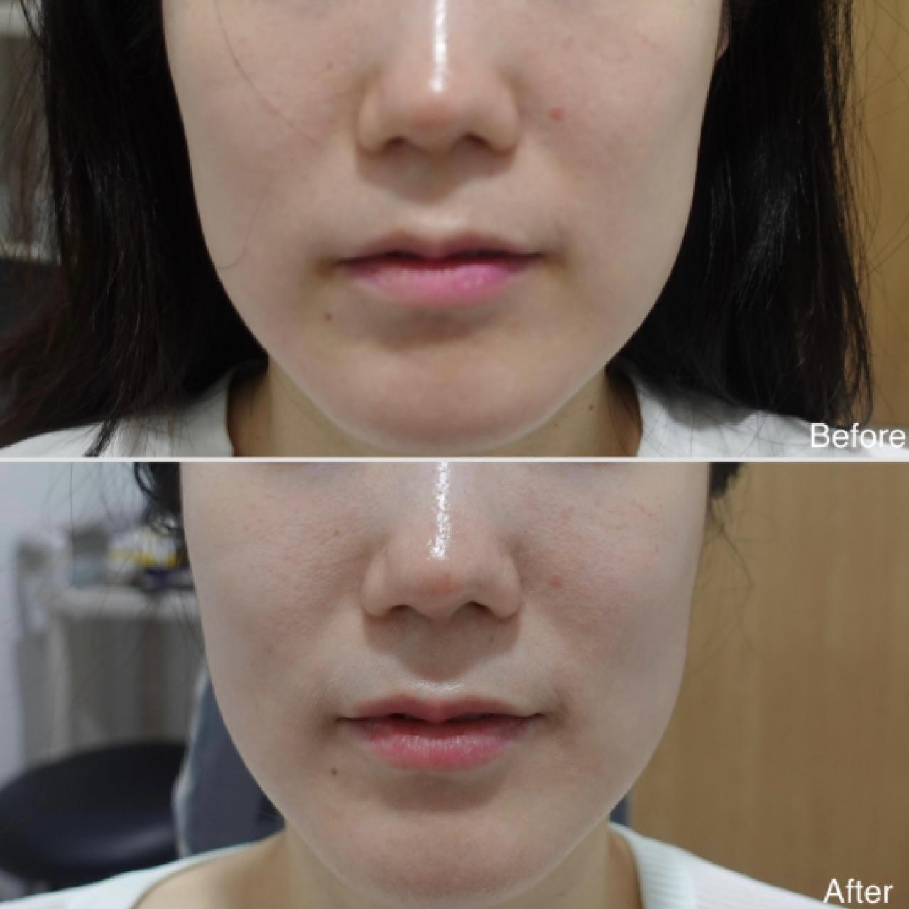 올리디아 옆볼 6cc