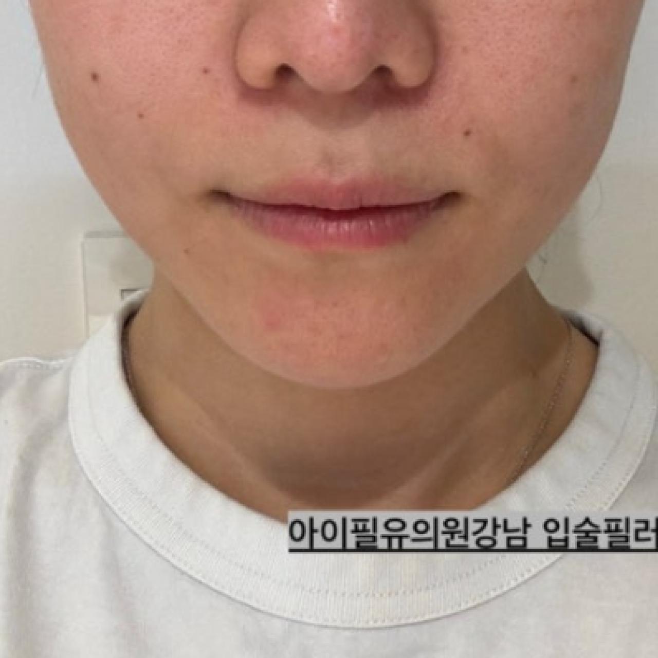 입술필러 1차 전 후