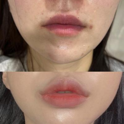 레스틸렌 키스 입술전용필러, 강남역 입술필러 잘 하는 곳 , 아이필유의원 강남 , 입술필러이벤트