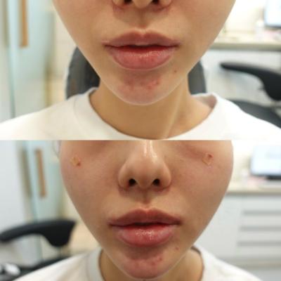 입술필러, 턱필러, 입술필러 잘하는 곳