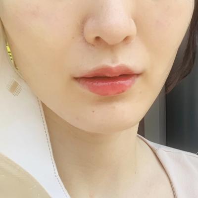 레스틸렌 키스 , 입술전용필러 , 강남역 입술필러 잘 하는 곳 , 시술 전 후 사진