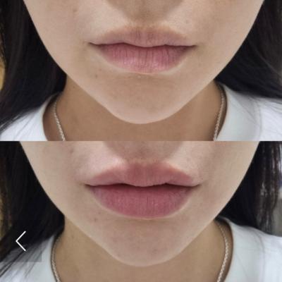 입술필러 전 후 사진, 권혜련원장, 아이필유의원강남, 입술필러후기