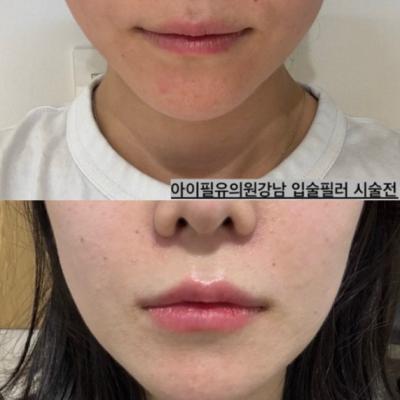 입술필러 , 얇은 입술 볼륨 늘리기, 입술필러이벤트, 자연스러운 볼륨 확대 , 전후사진